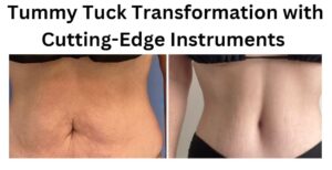 A Stunning Tummy Tuck Transformation by Dr. Cat Begović